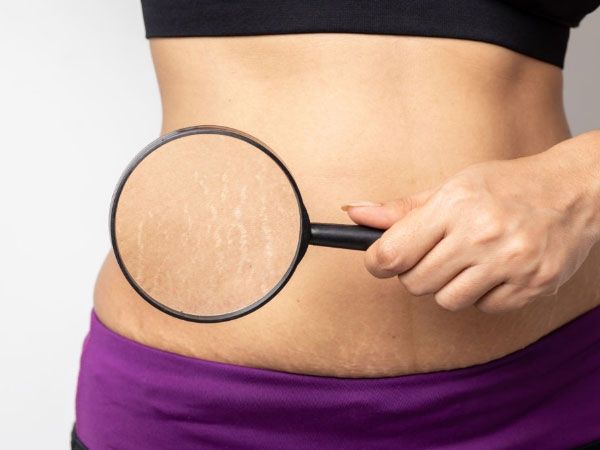 causes_of_cellulite (1)