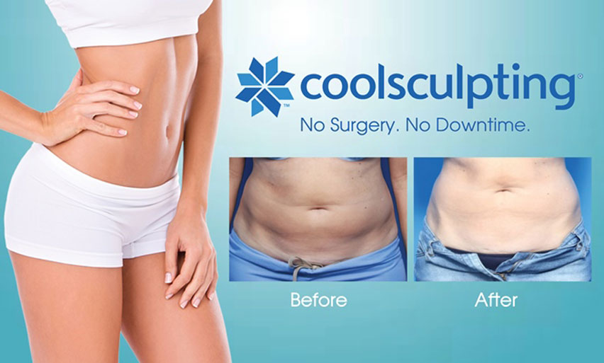 cool sculpting image cool Sculpting in Atlanta GA